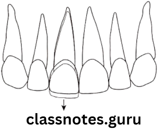 Orthodontics Classification Of Malocclusion Supra occlusion