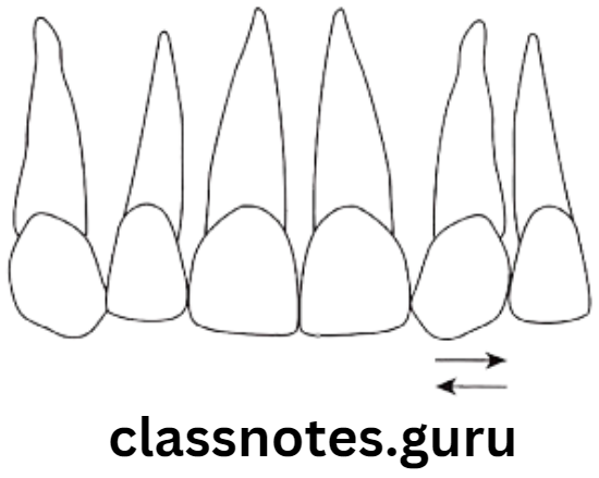 Orthodontics Classification Of Malocclusion Transposition