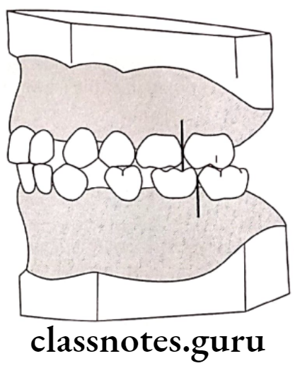 Orthodontics Development Of Dentition And Occlusion Distal step terminal plane