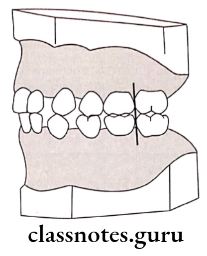 Orthodontics Development Of Dentition And Occlusion Flush terminal plane