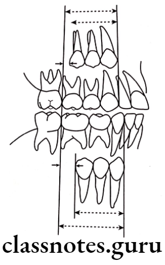 Orthodontics Development Of Dentition And Occlusion Leeway space of Nance