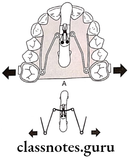 Orthodontics Expansion Quad helix activation for molar expansion
