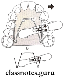 Expansion In Orthodontics Question And Answers - Class Notes