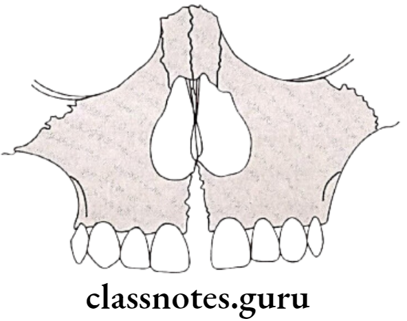 Orthodontics Expansionn Triangular split of the maxilla in frontal view