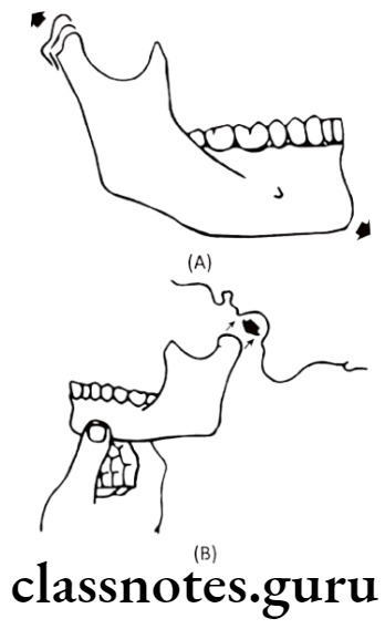Orthodontics Growth And Development Of Cranial And Facial Region Mandibular growth due to bone deposition