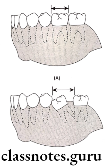 Orthodontics Methods Of Gaining Space A tilted tooth occupies more arch space than an upright one