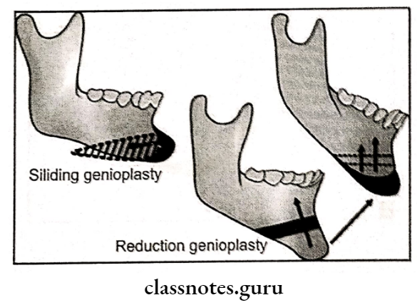 Orthognathic Surgery And Osteotomy Procedures Sliding And Reduction Genioplasty
