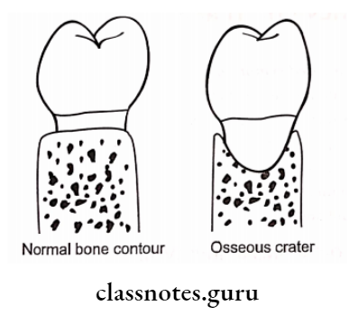 Osseous Defects In Periodontic Disease Diagrammatic representation of an osseous crater in a faciolingual section between two lower molars
