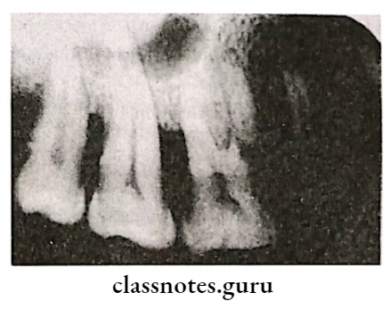 Osseous Defects In Periodontic Disease Radiographic illustration of horizontal bone loss