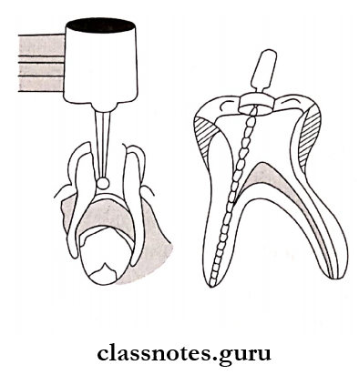 Pediatric Consideration For Oral Surgery Access opening and Use an endodontic file to remove the infected plup
