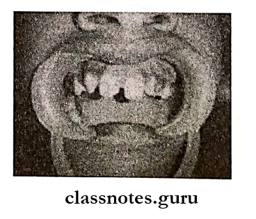 Pediatric Consideration For Oral Surgery Eill class 1 fracture involving the maxillary right permanent central incisor