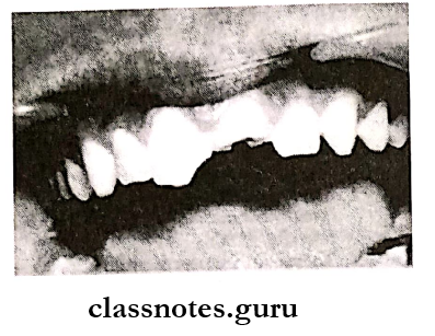 Pediatric Consideration For Oral Surgery Eill class 3 fracture involving consideable dentin and exposing the dental pulp of maxillary left permanent central incisor