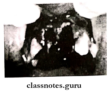 Pediatric Consideration For Oral Surgery Eill class 5 Tooth lost as a result of trauma
