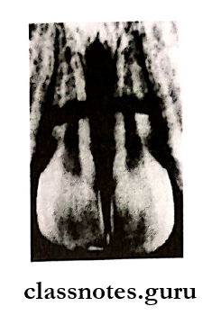 Pediatric Consideration For Oral Surgery Eill class 6 Radiograph showing horizontal fracture of the roots involving middle 3rd of maxillary central incisors