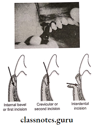 Periodontal Flap Horizontal incisions