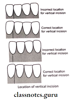 Periodontal Flap Location of vertical incision