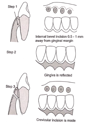 Periodontal Flap Modified widified flap-various steps