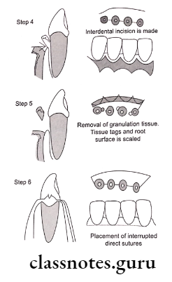 Periodontal Flap Modified widified flap-various steps.