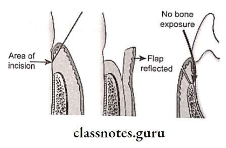 Periodontal Flap Partial and split thickness flap