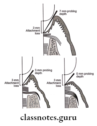 Periodontal Pocket Relation of loss attachment