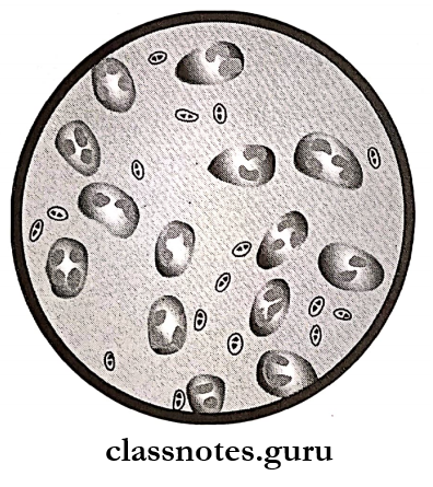 Pneumococcus - Str. Pneumoniae in pus