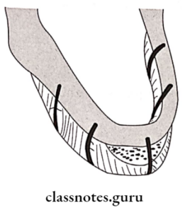 Pre Prosthetic Surgery - Class Notes