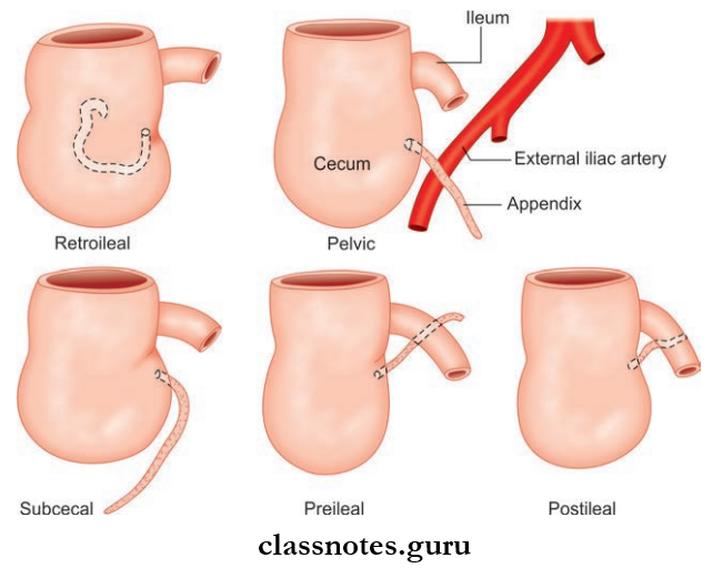 Small And Large Intestines Various Positions Of The Vermiform Appendix