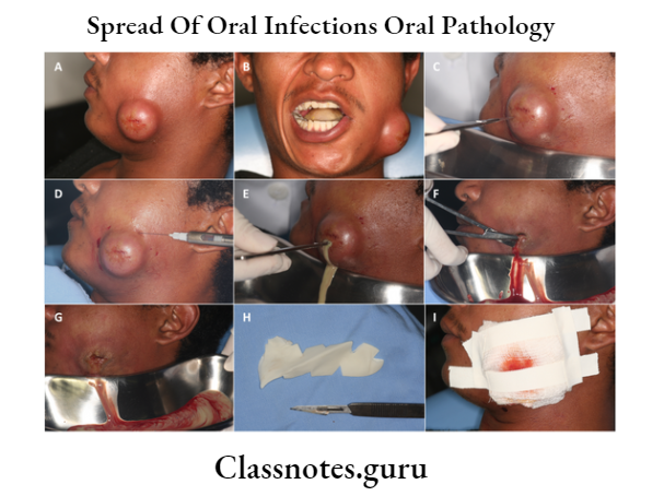 Spread Of Oral Infections Oral Pathology