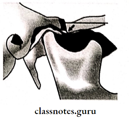Temporomandibular Joint Disorders Dautrys Zygomatic Arch Osteotmy