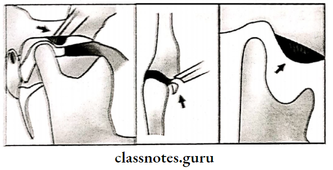 Temporomandibular Joint Disorders Diagrammatic Picture Of Eminectomy Procedure