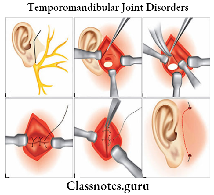Temporomandibular Joint Disorders Preauricular Incision