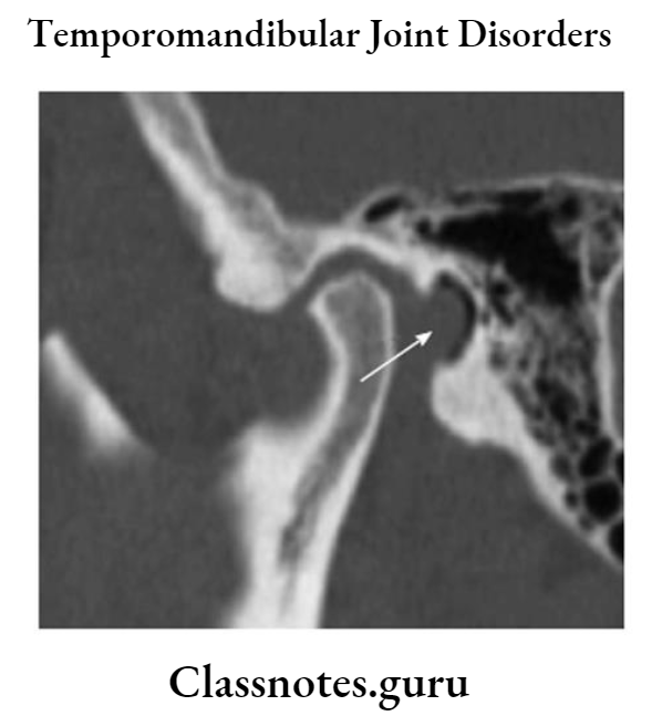 Temporomandibular Joint Disorders Three D Scan Showing The Position Of Condylar Head