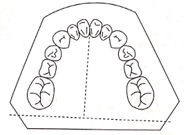 The back of the mandibular model is trimmed perpendicular to the midline