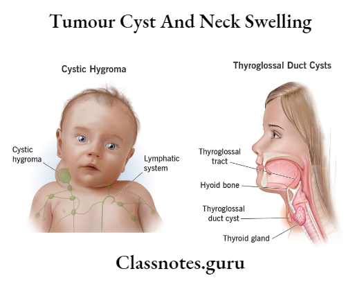Tumour Cyst And Neck Swelling C ystic Hygroma And Thyroglossal Duct Cysts