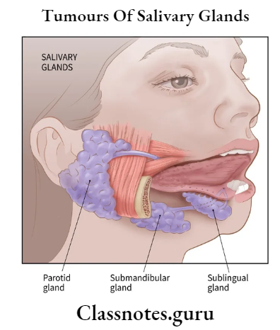 Tumours Of Salivary Glands