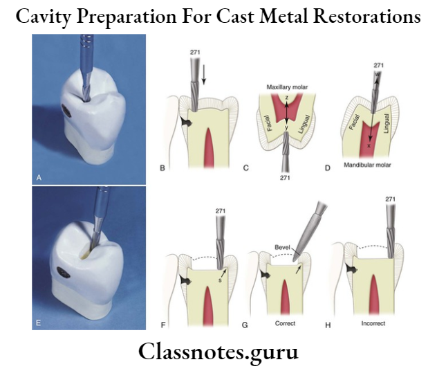 Cavity Preparation For Cast Metal Restorations