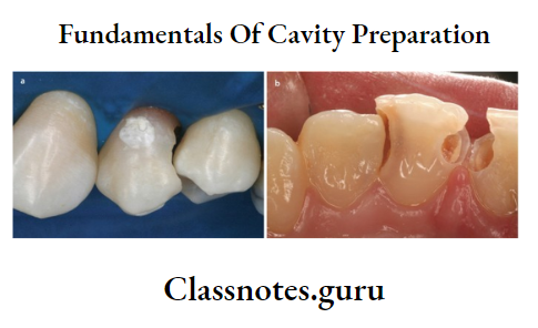 Fundamentals Of Cavity Preparation