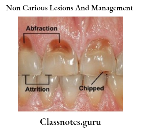 Non Carious Lesion Abfraction lesions may appear as minor cracks in early stages but in later stages they appear as grooves extending into dentin