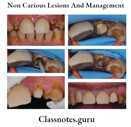 Non Carious Lesions And Management