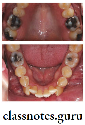 Orthodontics Extractions Extraction of First and Second Premolar