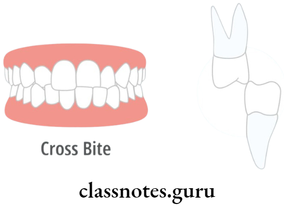 Orthodontics Fixed Appliances Cross Bite