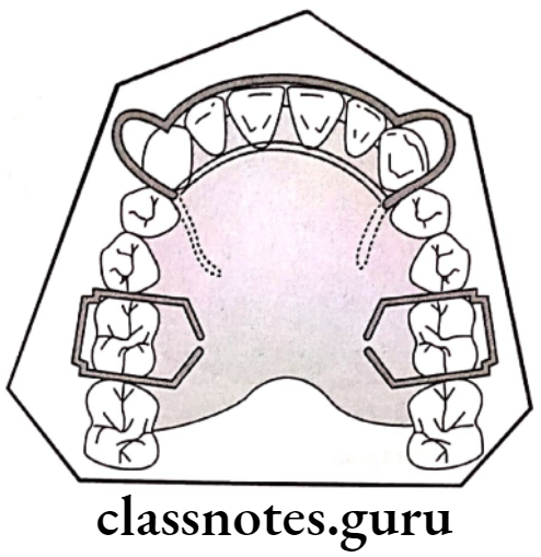 Orthodontics Management Of Malocclusion Anterior bite plane