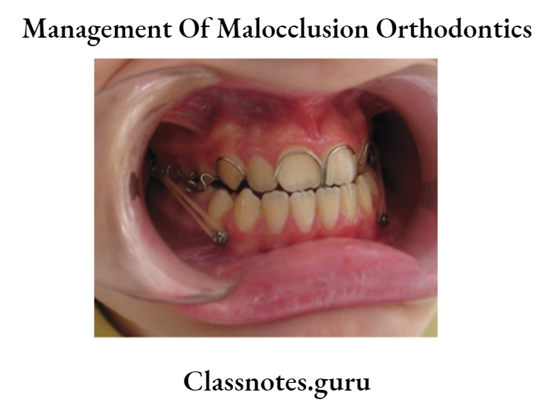 Orthodontics Management Of Malocclusion Chin cup appliances 1