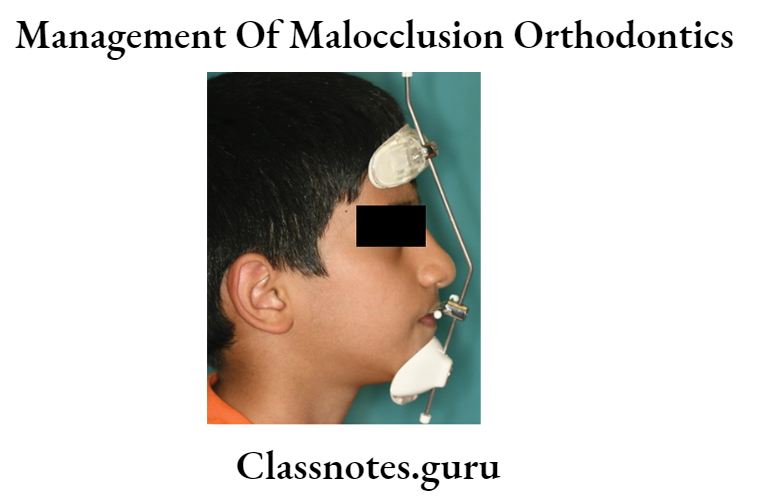 Orthodontics Management Of Malocclusion Chin cup appliances 1..
