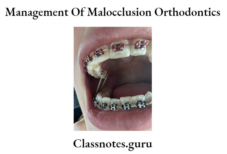 Orthodontics Management Of Malocclusion Crossbite elastics