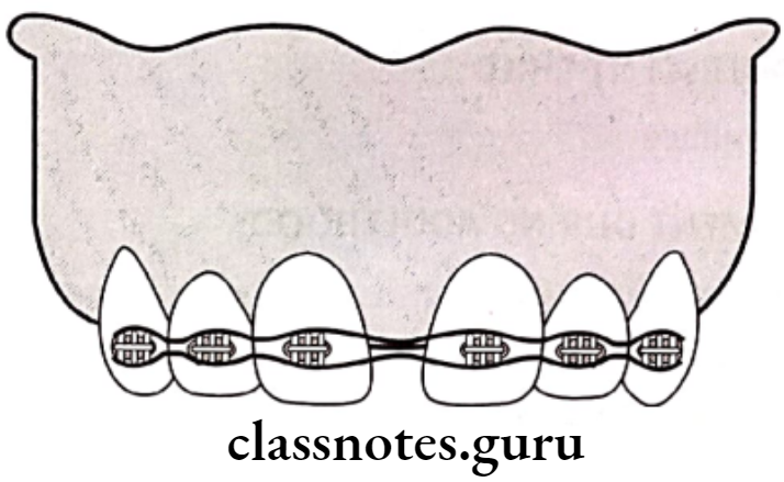 Orthodontics Management Of Malocclusion Elastic chain