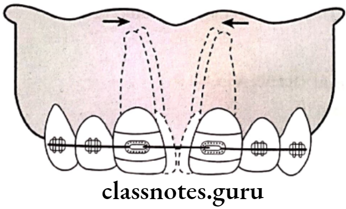 Orthodontics Management Of Malocclusion Elastics