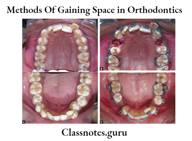 Orthodontics Methods Of Gaining Space Extraction of second premolar