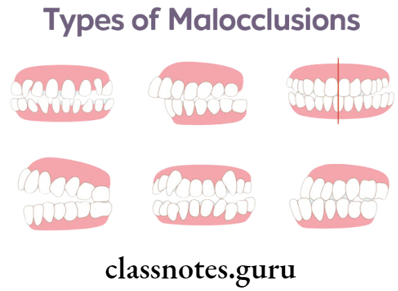 Orthodontics Myofunctional Appliances Malocclusions