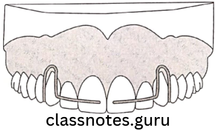Orthodontics Removable Appliances Split labial bow for retraction of anteriors